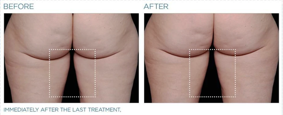 Regenerative Medicine Sarasota FL TeslaSculpt Before and After