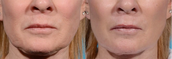 Two-panel close-up of a woman's lower face from Sarasota, FL, highlighting smoother skin and a tightened jawline after microneedling treatment, with clear skin texture improvements.